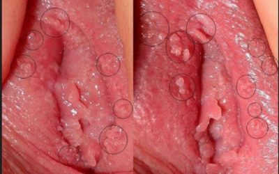 Mọc nhọt ở môi lớn vùng kín – Cảnh báo bệnh lý nguy hiểm