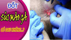 Sùi mào gà có đau không? Cách chữa trị không đau, không tái phát