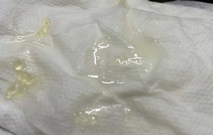 Cảnh báo vô sinh ở nam giới khi tinh trùng có hạt trắng như thạch