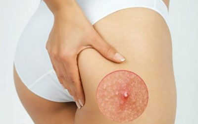 Tham khảo các cách trị mụn nhọt ở hậu môn tại nhà hiệu quả