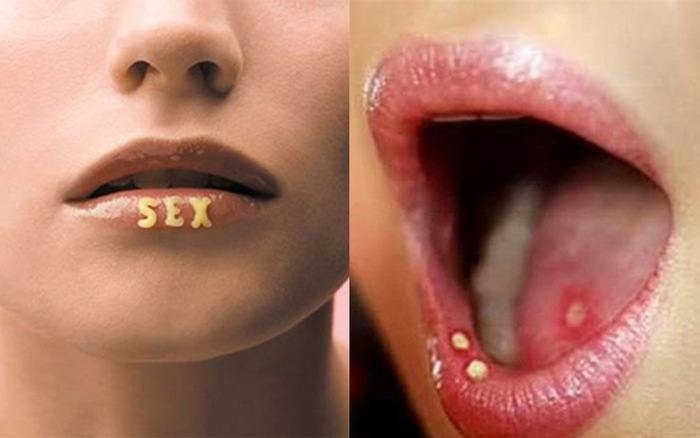 Quan hệ bằng miệng có lây bệnh xã hội không, lây như thế nào?