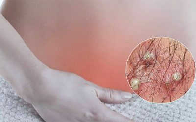 Hiểu hơn về bệnh viêm nang lông vùng kín và cách xử lý an toàn, triệt để