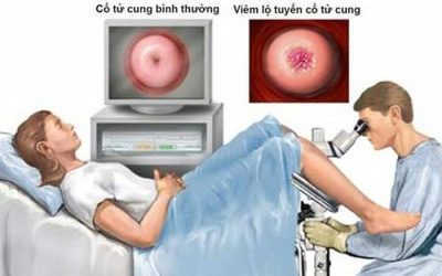 Đốt điện viêm lộ tuyến cổ tử cung có nhanh khỏi không?