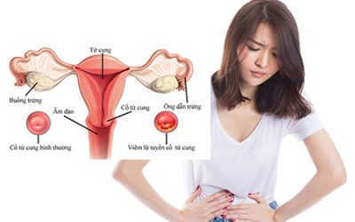 [Giải đáp] Viêm lộ tuyến cổ tử cung có mang thai được không?