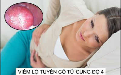 Viêm lộ tuyến cổ tử cung độ 4: Cảnh báo nguy hiểm bệnh ở giai đoạn nặng
