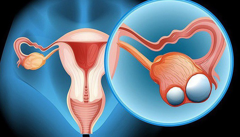 U nang buồng trứng vẫn có thể biến chứng ung thư