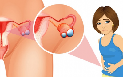 U nang buồng trứng gây rối loạn kinh nguyệt – Chớ dại chủ quan!