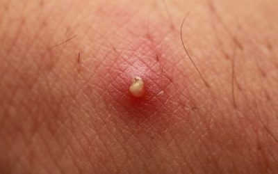 Dương vật nổi mụn trắng cảnh báo đang mắc phải bệnh lý gì?