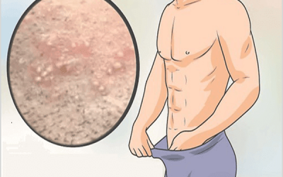 Nổi mụn ở đầu dương vật: Nguyên nhân và cách điều trị hiệu quả