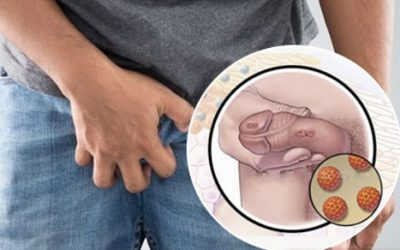 Mụn nước ở dương vật là bệnh gì? Địa chỉ chữa bệnh uy tín tại Hà Nội