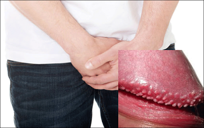 Sẩn ngọc dương vật: Nguyên nhân và cách điều trị hiệu quả