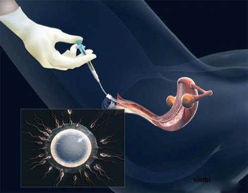 Phương pháp bơm tinh trùng