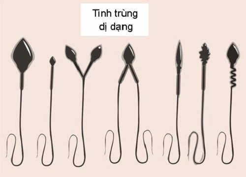 Tinh trùng dị dạng có thụ thai được không, cải thiện như thế nào?