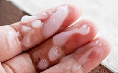 Tinh trùng vón cục như thạch: nguyên nhân, dấu hiệu và cách chữa