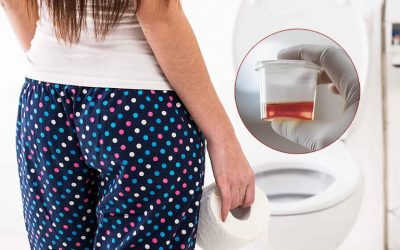 Tiểu rắt tiểu buốt ra máu là gì? Có nguy hiểm hay không?