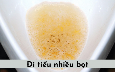 Vì sao đi tiểu nhiều bọt? Dấu hiệu này cảnh báo tình trạng gì?