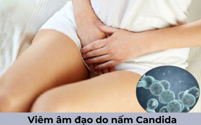 Bị viêm âm đạo do nấm candida có sao không?