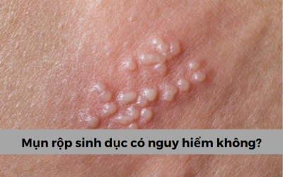 [Giải đáp thắc mắc] Mụn rộp sinh dục có nguy hiểm không?