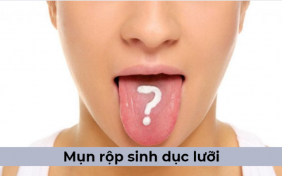 Mụn rộp sinh dục lưỡi là gì, có nguy hiểm không? [Bác sĩ giải đáp]