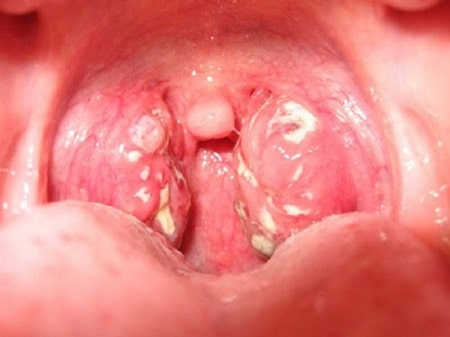 Mụn rộp sinh dục ở họng là bệnh gì?