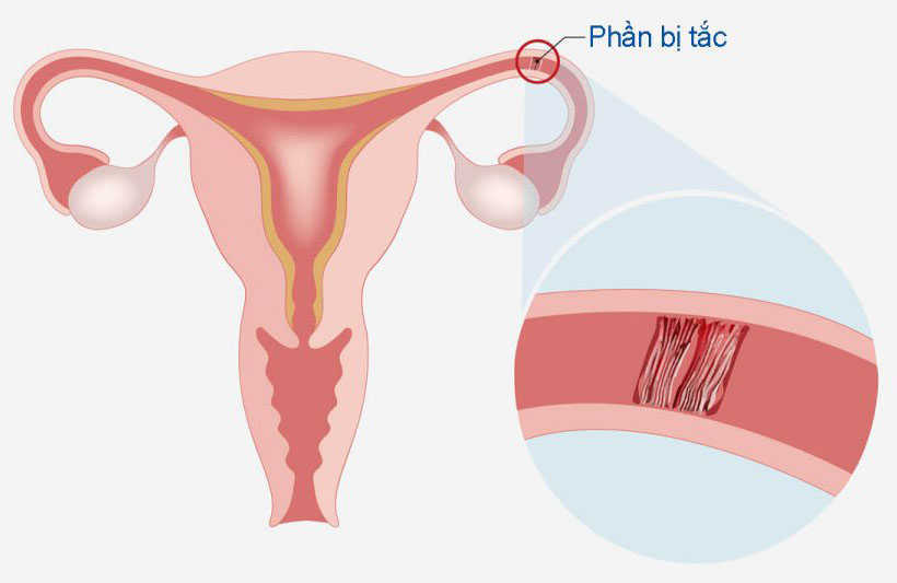 Tắc vòi trứng ở nữ giới là bệnh gì?