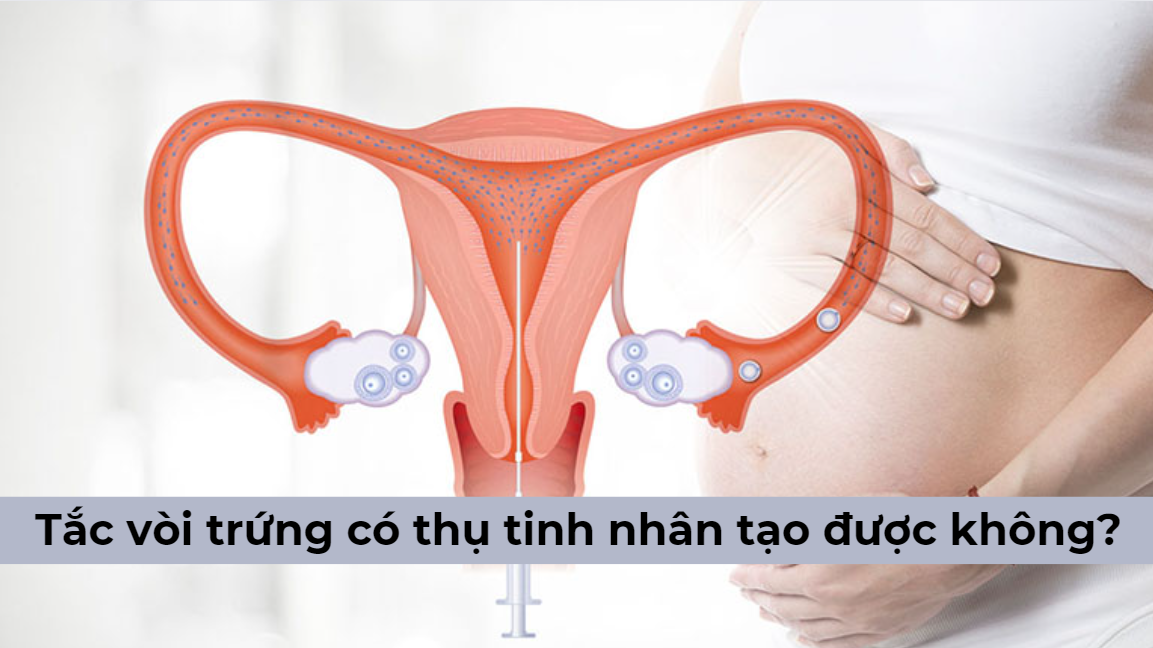 Bị tắc vòi trứng có thụ tinh nhân tạo được không? [Chuyên gia giải đáp]
