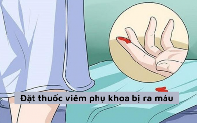 Đặt thuốc viêm phụ khoa bị ra máu có sao không, điều trị thế nào?