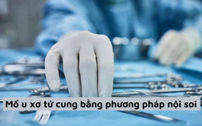 Thông tin cần biết về mổ u xơ tử cung bằng phương pháp nội soi