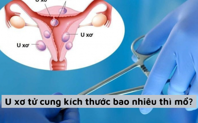 Giải đáp thắc mắc: U xơ tử cung kích thước bao nhiêu thì mổ được?