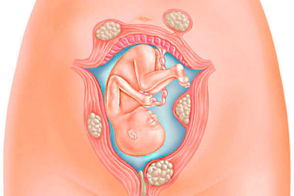Tác hại của u xơ tử cung đến thai kỳ