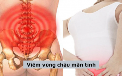Tìm hiểu viêm vùng chậu mãn tính: Dấu hiệu, nguyên nhân và cách điều trị