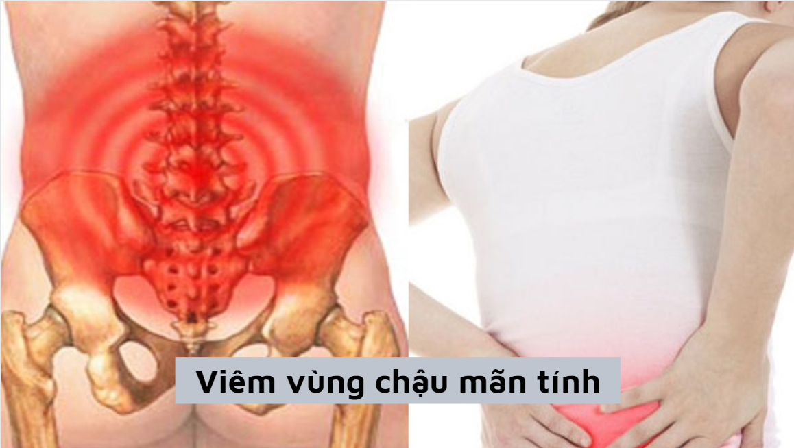 Tìm hiểu viêm vùng chậu mãn tính: Dấu hiệu, nguyên nhân và cách điều trị