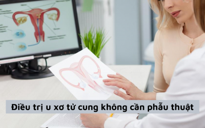 Tổng hợp phương pháp điều trị u xơ tử cung không cần phẫu thuật