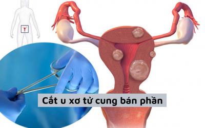 [Tìm hiểu] Cắt u xơ tử cung bán phần – chia sẻ từ chuyên gia