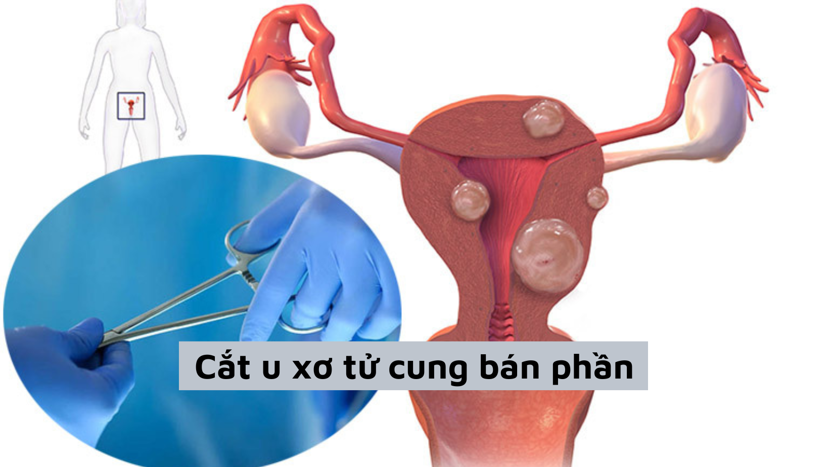 [Tìm hiểu] Cắt u xơ tử cung bán phần – chia sẻ từ chuyên gia