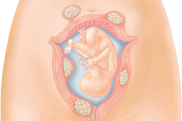 U xơ tử cung có ảnh hưởng tới thai nhi