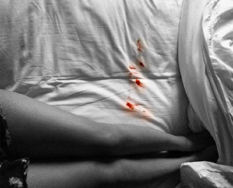 Nữ giới khi bị rách màng trinh có ra nhiều máu không?