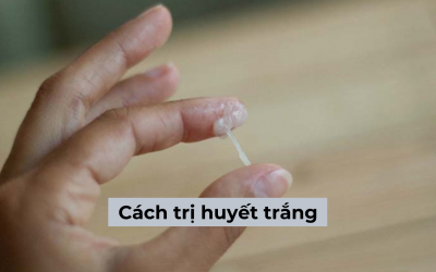 [Tổng hợp] Các cách trị huyết trắng hiệu quả, dễ áp dụng cho chị em 