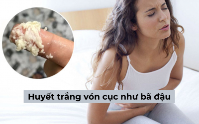 Huyết trắng vón cục như bã đậu và những thông tin bạn không nên bỏ lỡ