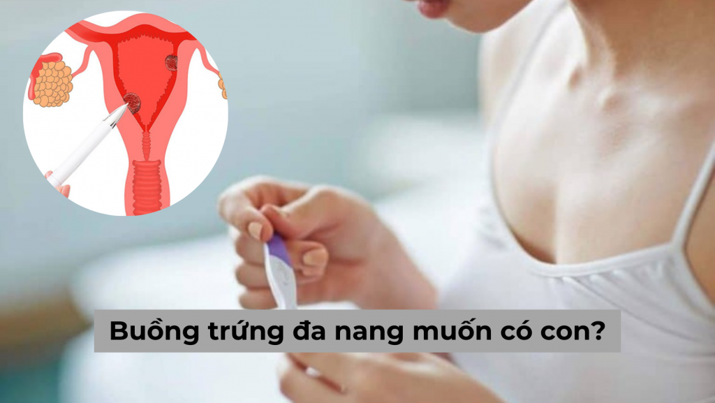 [Giải đáp thắc mắc] Buồng trứng đa nang muốn có con phải làm gì?