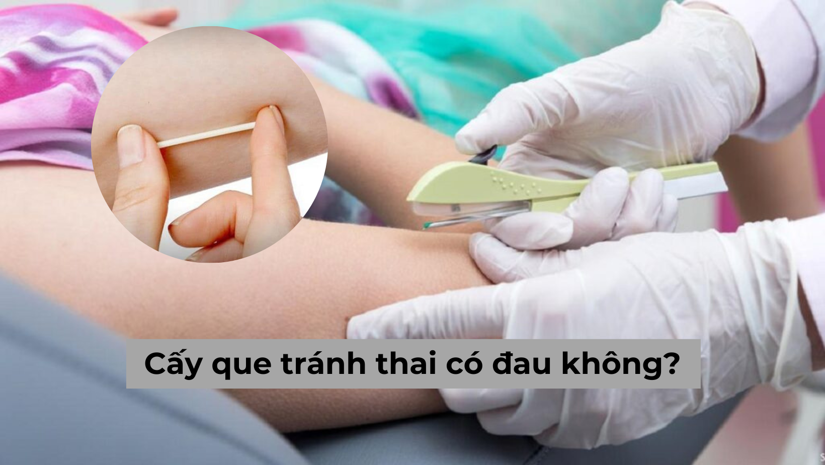 Cấy que tránh thai có đau không? Nên hay không nên cấy que?