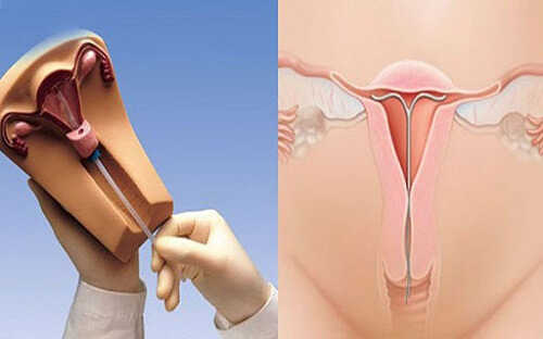 Cảm nhận vị trí bất thường của vòng tránh thai
