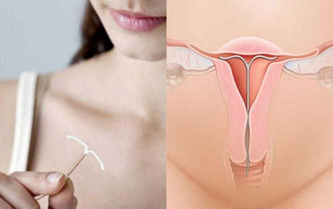 Nguyên nhân nào dẫn tới hiện tượng vòng tránh thai bị lệch
