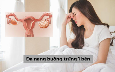 [Tìm hiểu] Đa nang buồng trứng 1 bên như thế nào và cách chữa hiệu quả