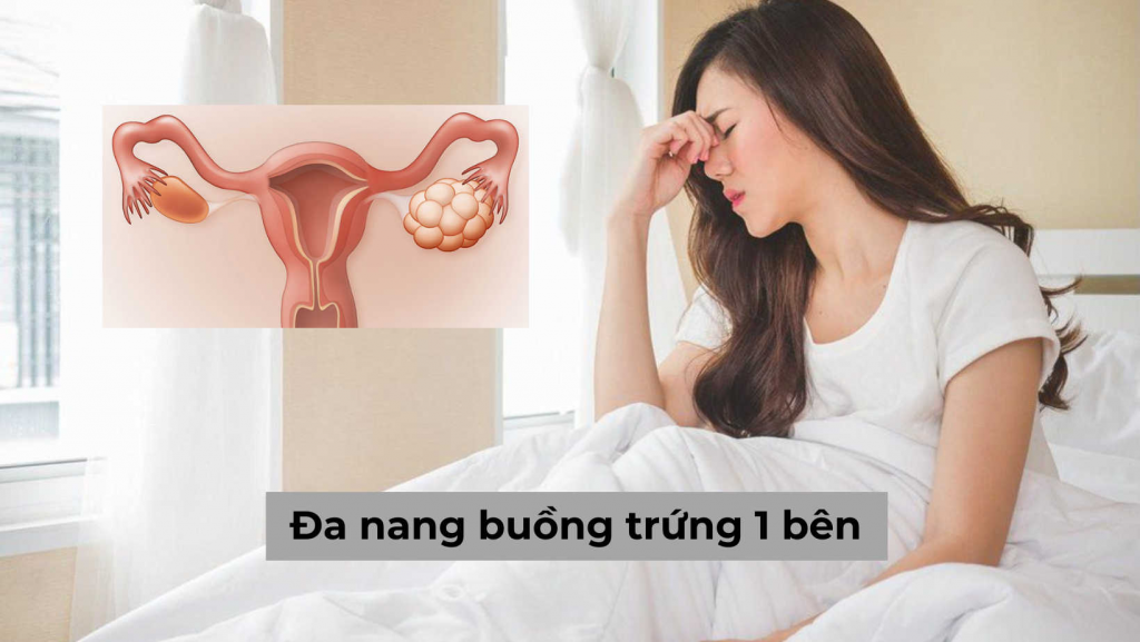 [Tìm hiểu] Đa nang buồng trứng 1 bên như thế nào và cách chữa hiệu quả