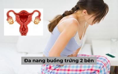 Đa nang buồng trứng 2 bên: Nguyên nhân, dấu hiệu và cách điều trị