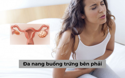 Đa nang buồng trứng bên phải và một số thông tin chị em nên biết