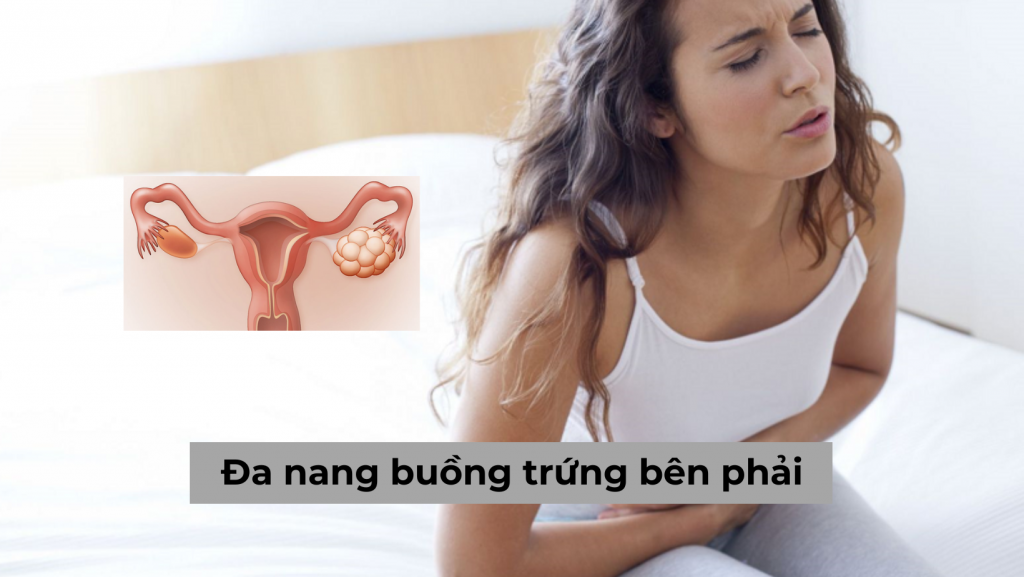 Đa nang buồng trứng bên phải và một số thông tin chị em nên biết