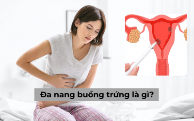 Đa nang buồng trứng là gì? Những biến chứng nguy hiểm có thể gặp phải