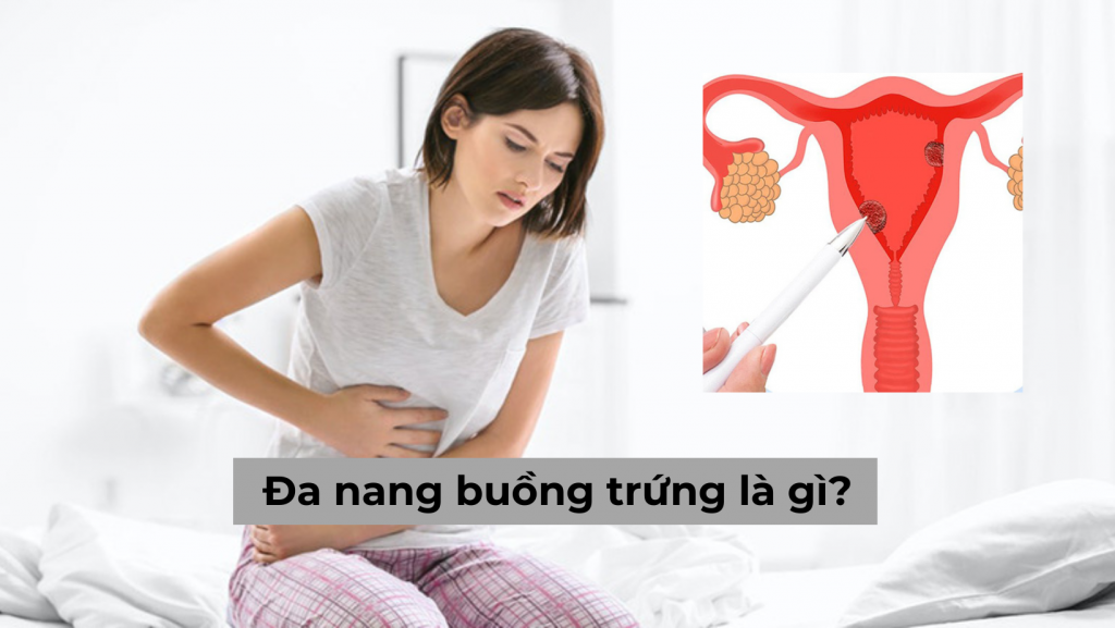 Đa nang buồng trứng là gì? Những biến chứng nguy hiểm có thể gặp phải